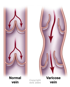 Bloodflow chart in varicose vein