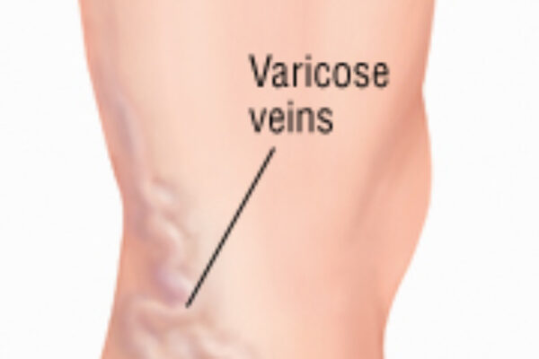 Placeholder Image for Myths about Varicose Veins
