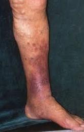 Ankle discoloration