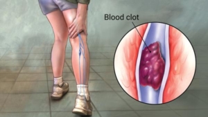 DVT and blood clot