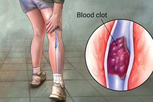 Image for Varicose Vein Treatment Reduces Risks of DVT