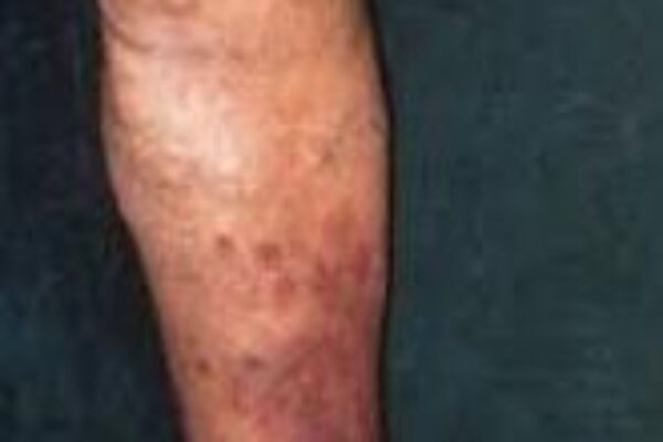 Image for Ankle Discoloration: A Symptom of Vein Disease