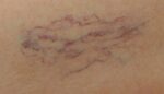 Spider vein before treatment