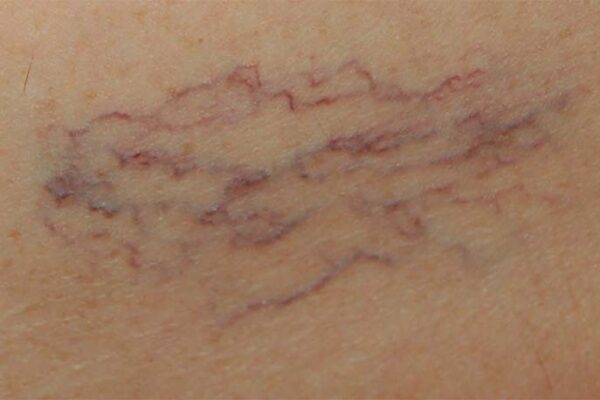 Image for Do Spider Veins Ever Go Away on their Own?