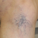 Spider vein before sclerotherapy