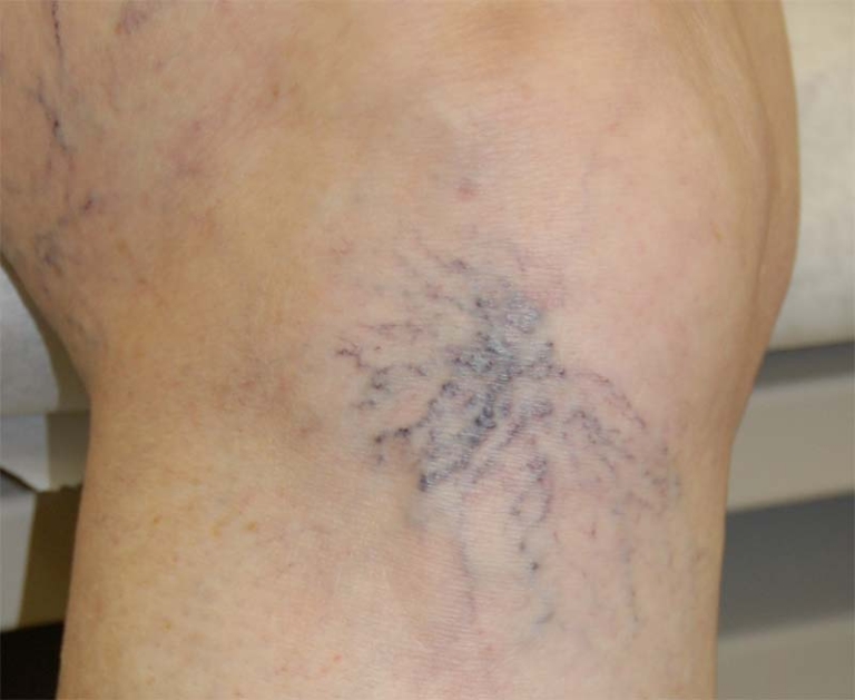 Do Spider Veins Go Away On Their Own? Inovia Vein