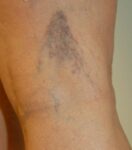 Closeup of spider vein with reticulars