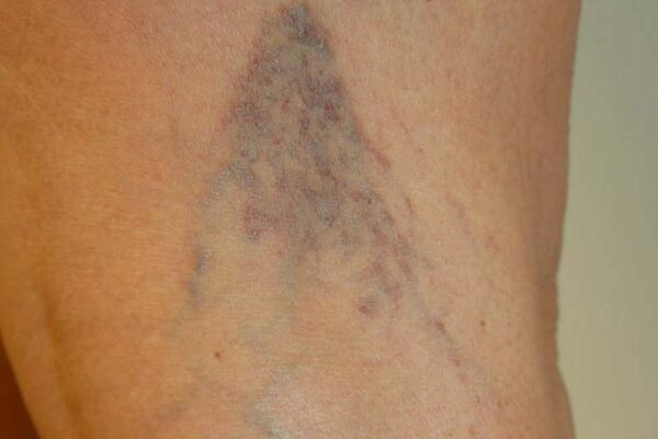 Image for Painful Varicose Veins  During Pregnancy