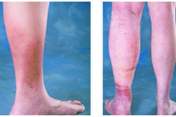 Placeholder Image for Ankle Discoloration Can Signal Serious Vein Problems