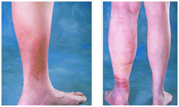 Ankle Discoloration Can Signal Serious Vein Problems