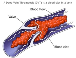 DVT blood clot graphic