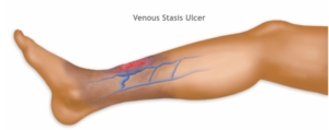 venous stasis ulcer diagram