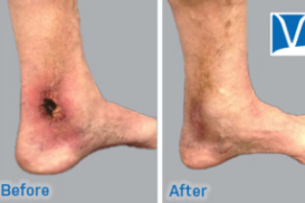 Placeholder Image for Treating Varicose Vein Skin Changes