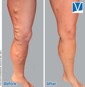 Endovenous ablation before and after