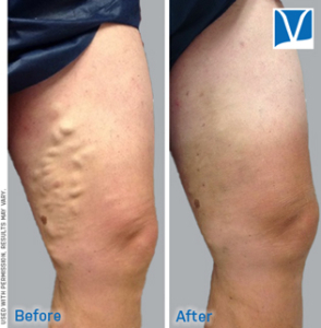 endovenous ablation of varicose veins