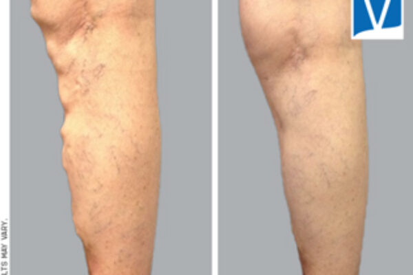 Image for How to Prevent Varicose Veins