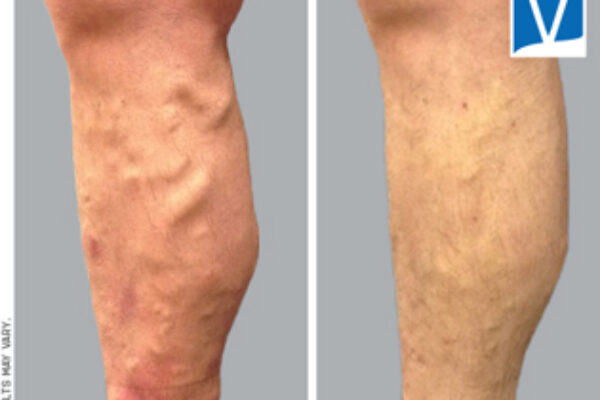 Image for Can Varicose Veins Cause a Skin Rash?
