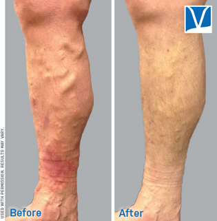 varicose vein sclerotherapy before and after