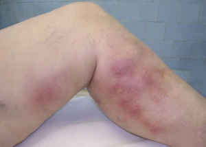 example of superficial vein phlebitis in leg