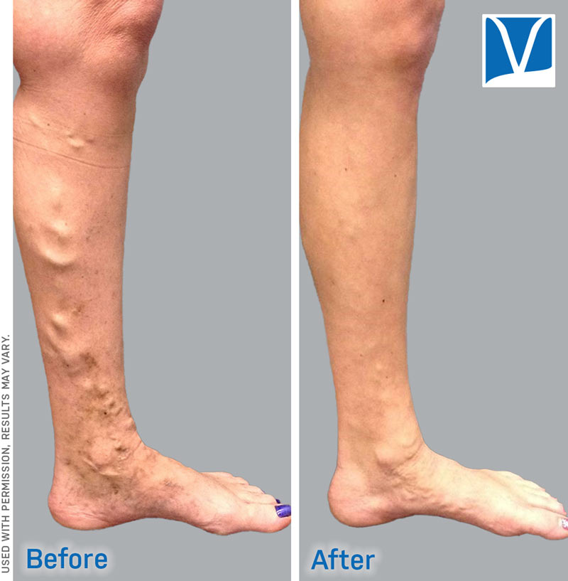 Vein ablation before and after