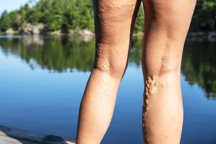 Legs of a mature woman with varicose veins