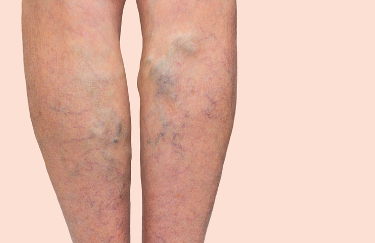 varicose veins on back of legs