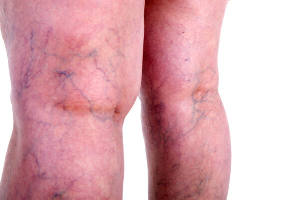Image for Sudden Prominent Blue Veins: What Causes Veins to Be More Visible?