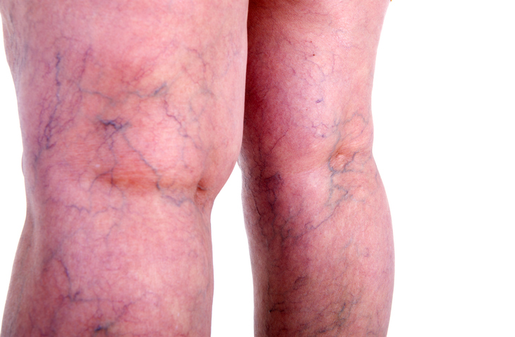 Spider veins on back of legs