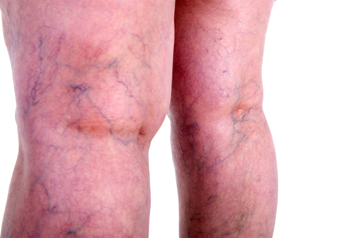 Why Do My Veins Appear Green? - Vascular Health