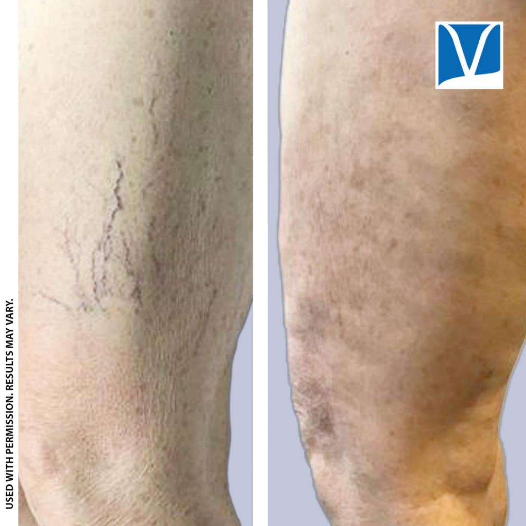 Spider vein sclerotherapy results