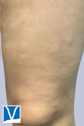 After 31 year old female varicose