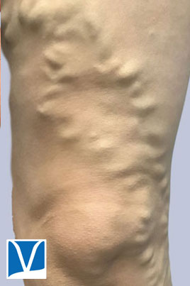 Before 31 year old female varicose