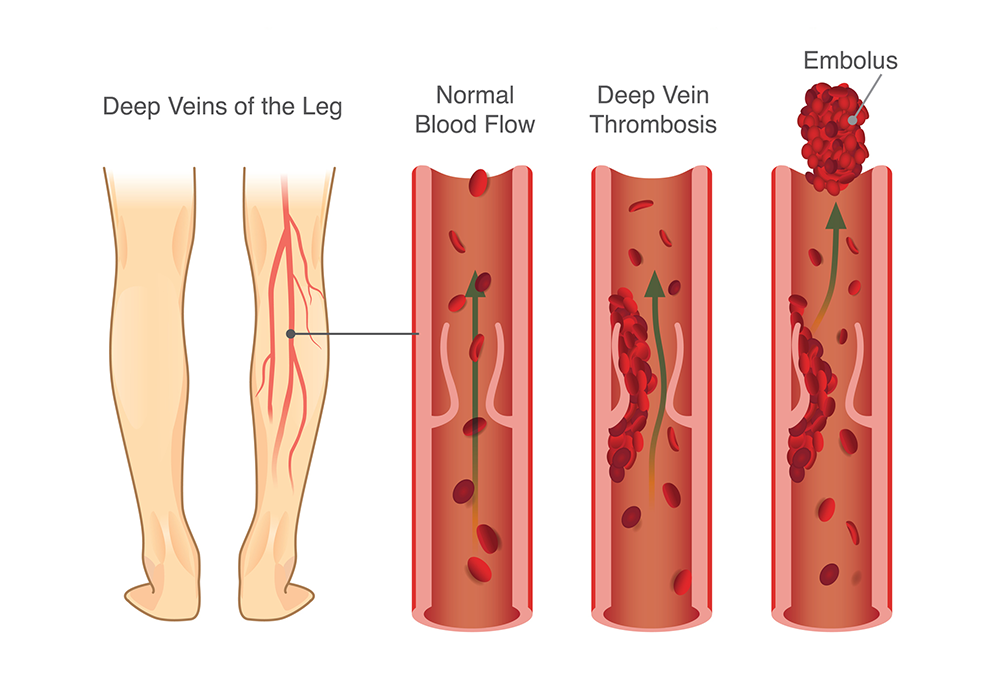 DVT illustration veins thrombosis embolus