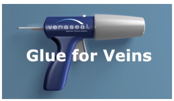 VenaSeal varicose vein treatment