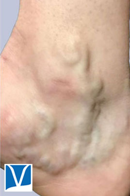 Before 45 year old woman ankle varicose