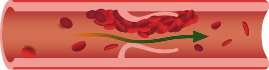 dvt clot illustration