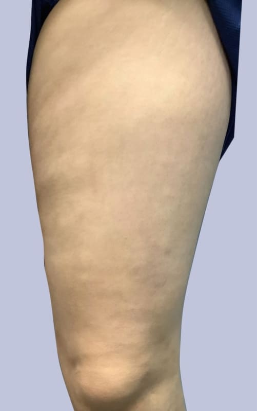 varicose veins after treatment results