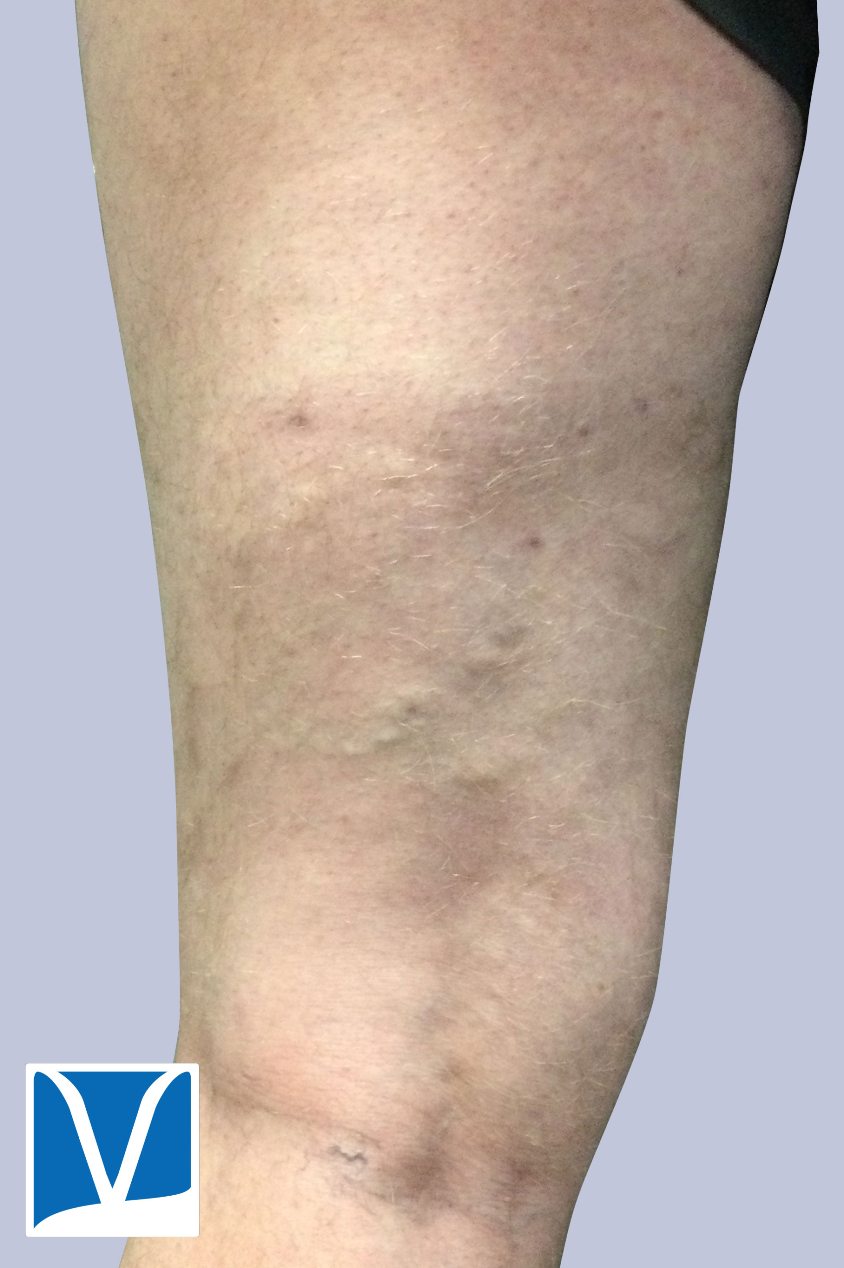 varicose veins after treatment