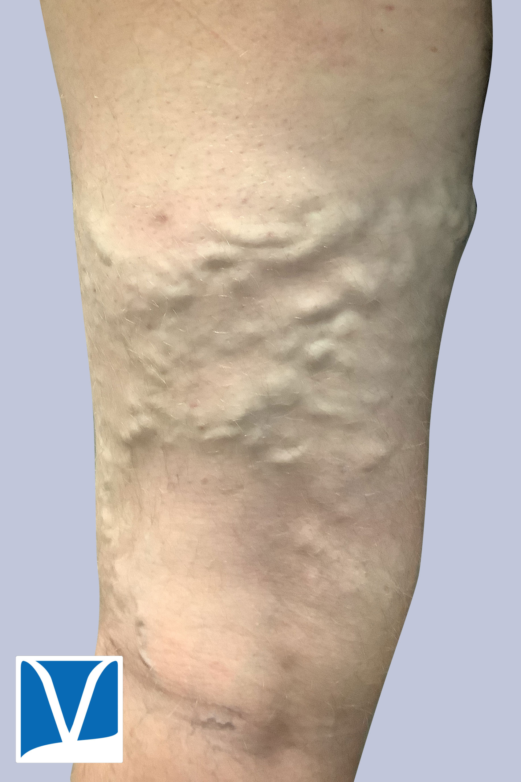 varicose veins before treatment
