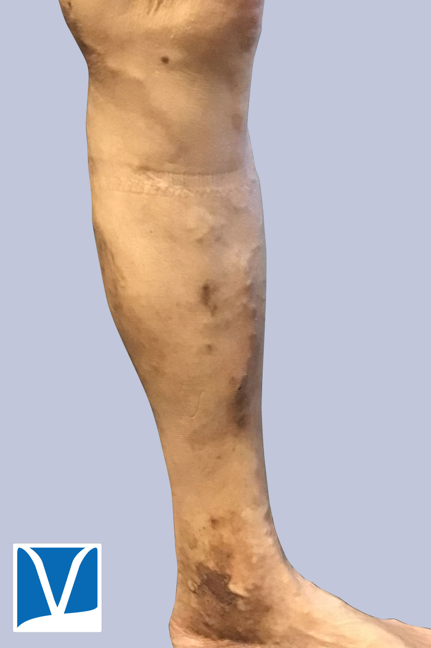varicose veins after treatment results