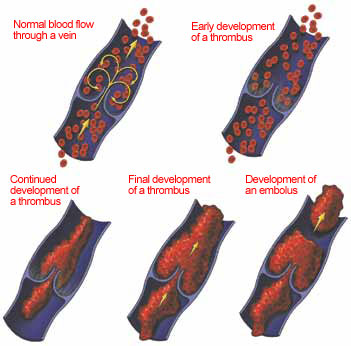 Examples of DVT stages