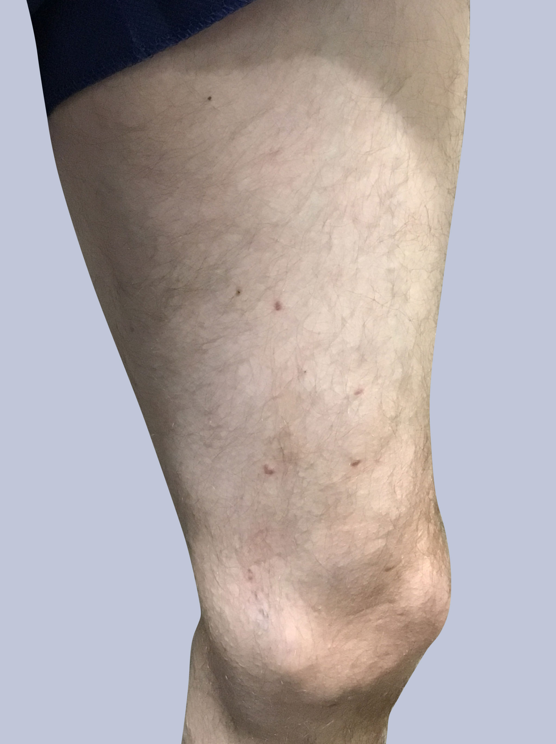 varicose after treatment