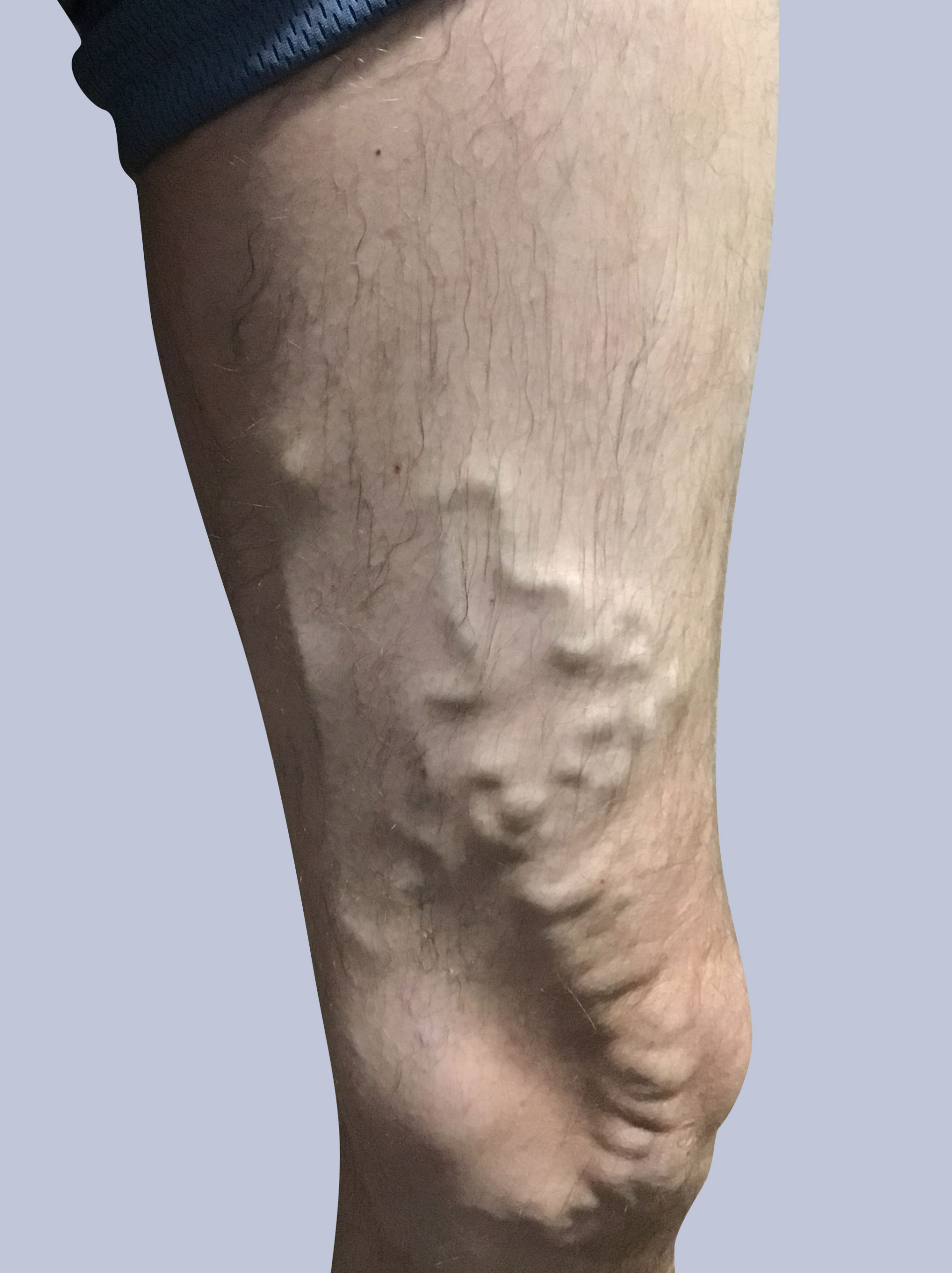 varicose before treatment