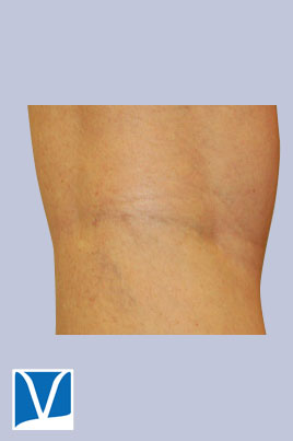 After Sclerotherapy 29