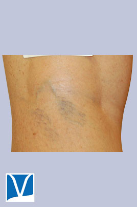 Before Sclerotherapy 29