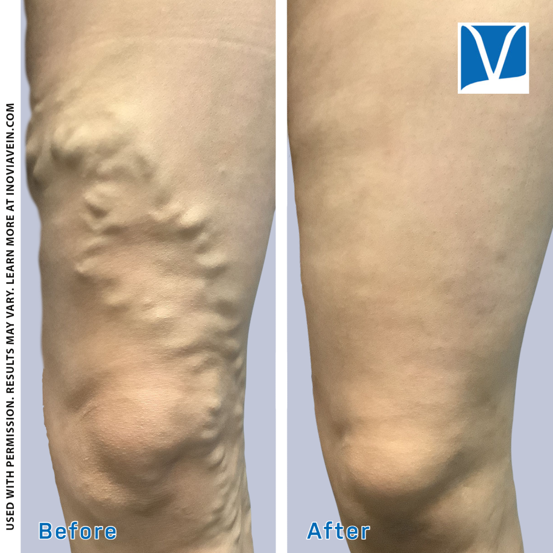 31 yr female left leg aching pain itch burning swelling RFA LLE GSV Sclero Sept 23 21 postproc coag drain Voltaren cream after 3 17 22
