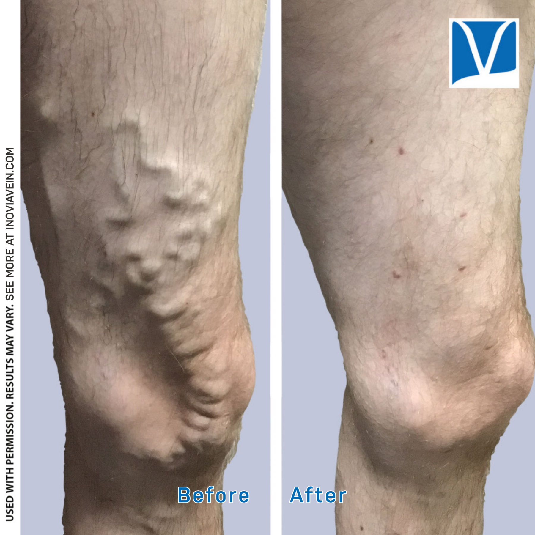 Before After Bend 35yo Male RadiofrequencyAblation AmbulatoryPhlebectome 7.20.21 11.18.21
