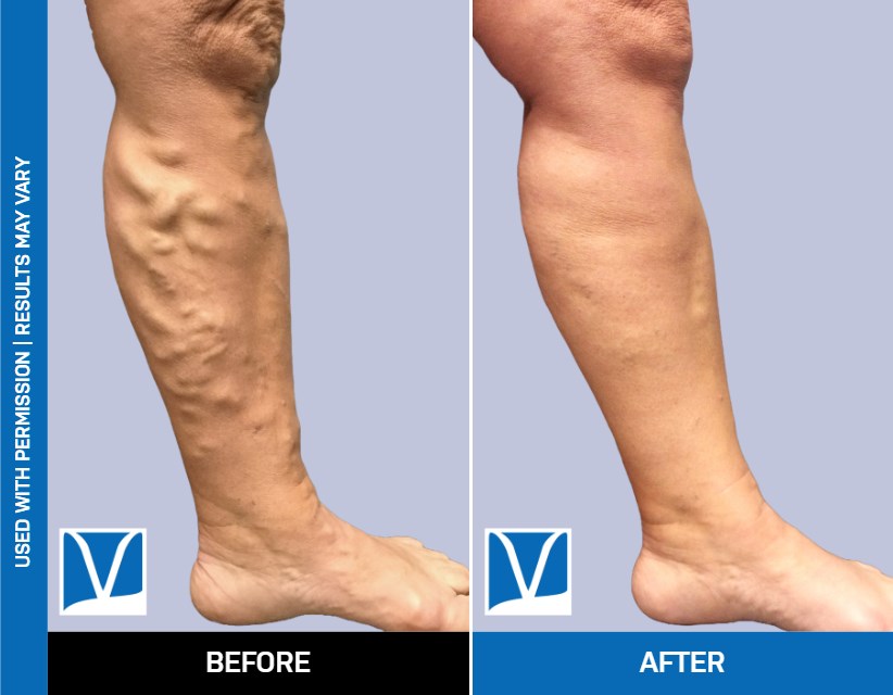 Are varicose vein costs covered by insurance