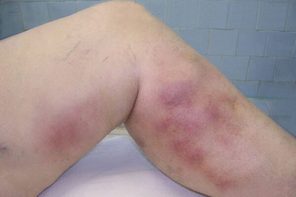 Image for Are Dark Blue and Brown Bruises on Legs Actually Varicose Veins?