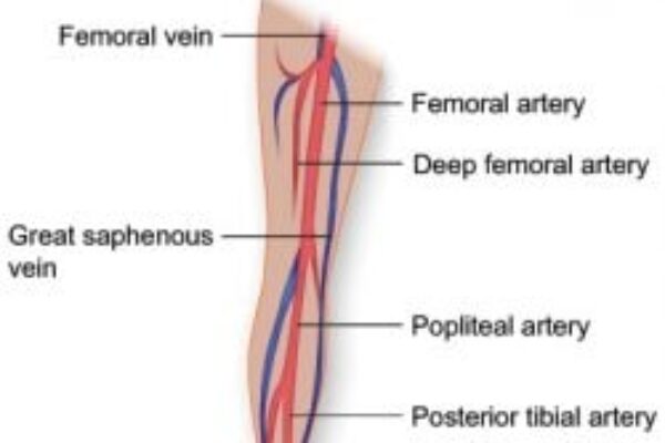 Placeholder Image for Connecting the Dots: Varicose Veins and Cancer Symptoms